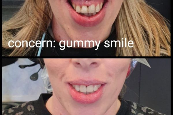 Rachael gummy smile before and after